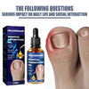 German Toenailcare Removal Paronychia Oil Ingrown Toenail Liquid Solution Repair Nail Renewal Best Nail Treatment K9w9